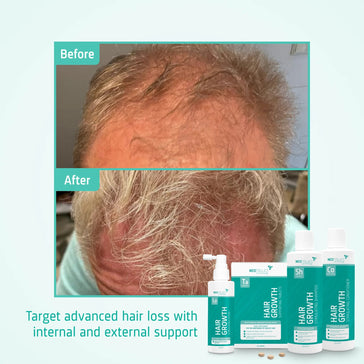 Neofollics Shampoo + Conditioner + Serum + Tabletten Behandlung von fortgeschrittenem erblich bedingtem Haarausfall bei Männern - Hairgivers
