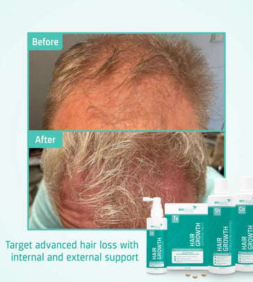 Neofollics Shampoo + Conditioner + Serum + Tabletten Behandlung von fortgeschrittenem erblich bedingtem Haarausfall bei Männern - Hairgivers