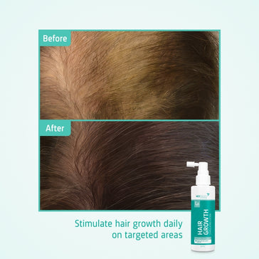 Neofollics Serum gegen Haarausfall (7% Neoxyl) Neofollics Serum gegen Haarausfall (7% Neoxyl) - Hairgivers