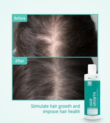 Neofollics Shampoo gegen Haarausfall (250 ml) Neofollics Shampoo gegen Haarausfall (250 ml) - Hairgivers