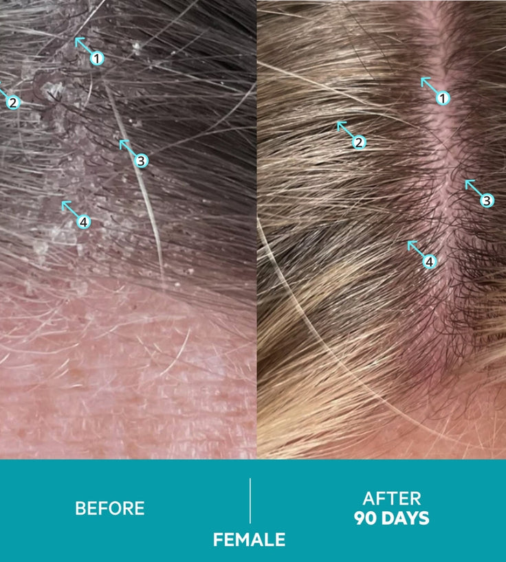 Dandrene Anti-Schuppen Shampoo