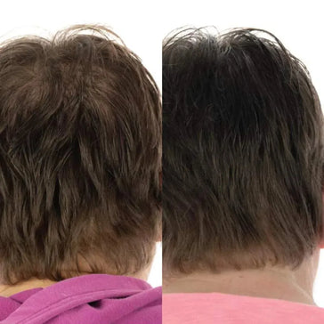 Foligain Shampoo + Lotion + Haarwuchs Kapseln (Frau) Foligain Haarwuchsbehandlung (Frau) - Hairgivers
