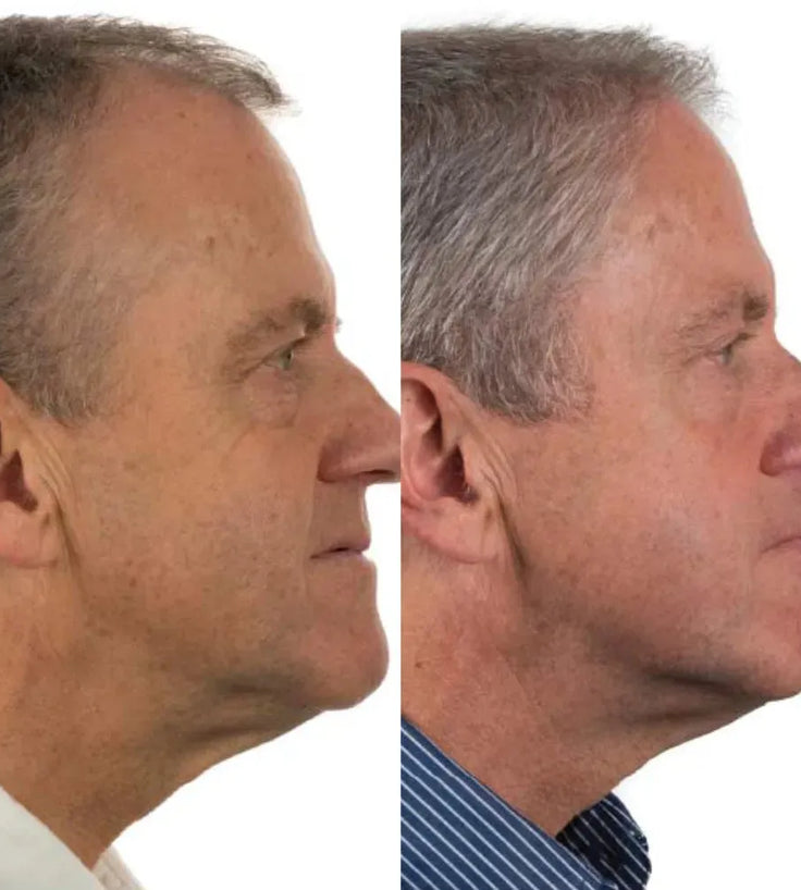 Foligain Shampoo + Conditioner für Männer (236 ml) Kombi-Packung - Hairgivers