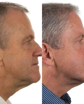 Foligain Shampoo gegen Haarausfall für Männer (236 ml) Foligain Shampoo gegen Haarausfall für Männer (236 ml) - Hairgivers