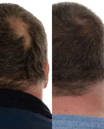 Foligain Shampoo gegen Haarausfall für Männer (236 ml) Foligain Shampoo gegen Haarausfall für Männer (236 ml) - Hairgivers