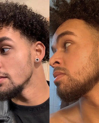 Neofollics Bartroller (0,5 mm) Neofollics Bartroller (0,5 mm) - Hairgivers