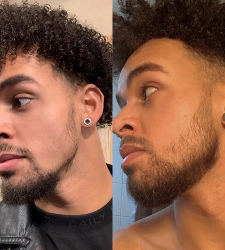 Neofollics Bartroller (0,5 mm) - Hairgivers