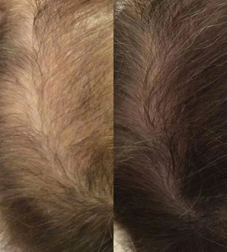 Neofollics Serum gegen Haarausfall (7% Neoxyl) - Hairgivers