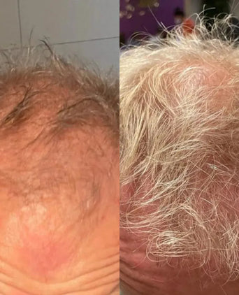 Neofollics Tabletten gegen Haarausfall 3-Pack Neofollics Tabletten gegen Haarausfall 3-Pack - Hairgivers