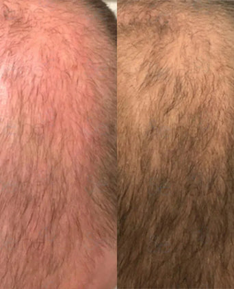 Panthrix Haarwuchs Aktivator (Redensyl) Serum Panthrix Haarwuchs Aktivator (Redensyl) Serum - Hairgivers