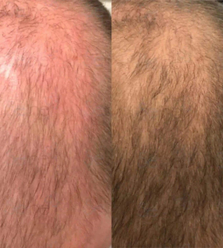 Panthrix Haarwuchs Aktivator (Redensyl) Serum - Hairgivers