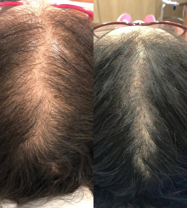 Revita Shampoo + Revita Conditioner Kombi-Packung (925 ml) - Hairgivers