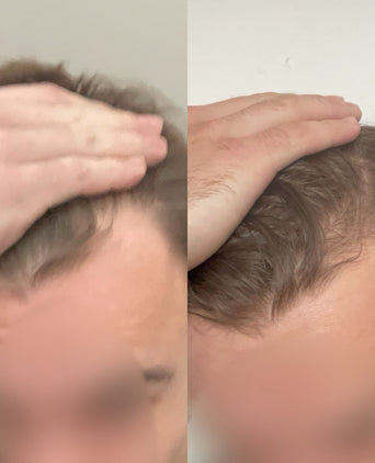 Scandinavian Biolabs Bio-Pilixin Hairline Booster Scandinavian Biolabs Bio-Pilixin Hairline Booster