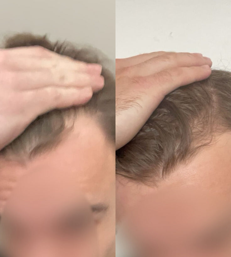 Scandinavian Biolabs Bio-Pilixin Hairline Booster Nachfüllung (1-Pack)