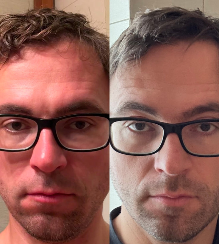 Scandinavian Biolabs Bio-Pilixin Hairline Booster Nachfüllung (1-Pack)