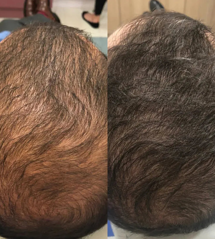 Spectral DNC-N (Nanoxidil) Haarserum - Hairgivers