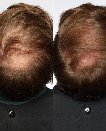 Theradome LH40 EVO Laserhelm Theradome LH40 EVO Laserhelm - Hairgivers