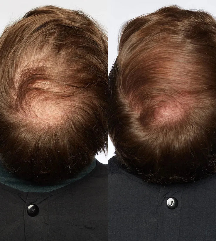 Theradome LH40 EVO Laserhelm - Hairgivers