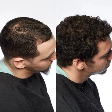 Theradome LH80 PRO Laserhelm Theradome LH80 PRO Laserhelm - Hairgivers