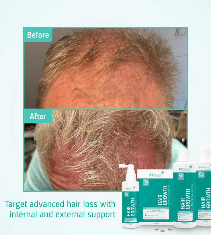 Neofollics Shampoo + Conditioner + Serum + Tabletten