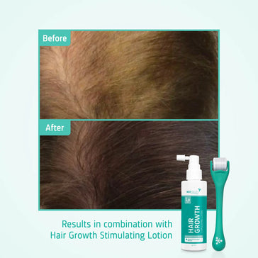 4x Neofollics Haarwachstums-Serum+ kostenloser Scalp Roller - Hairgivers