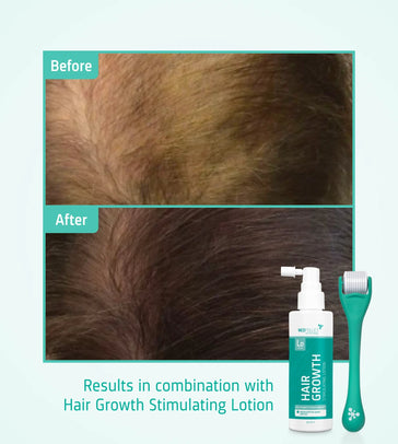 4x Neofollics Haarwachstums-Serum+ kostenloser Scalp Roller - Hairgivers