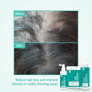 Behandlung von mäßigem erblich bedingtem Haarausfall bei Männern - Hairgivers