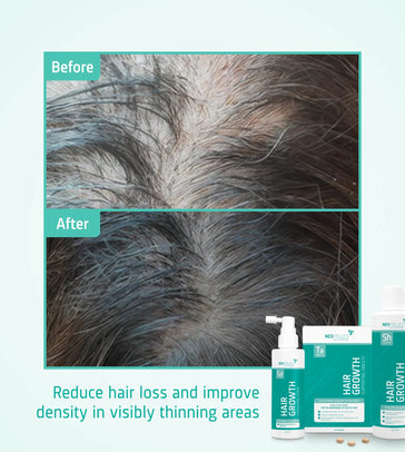 Behandlung von mäßigem erblich bedingtem Haarausfall bei Männern - Hairgivers