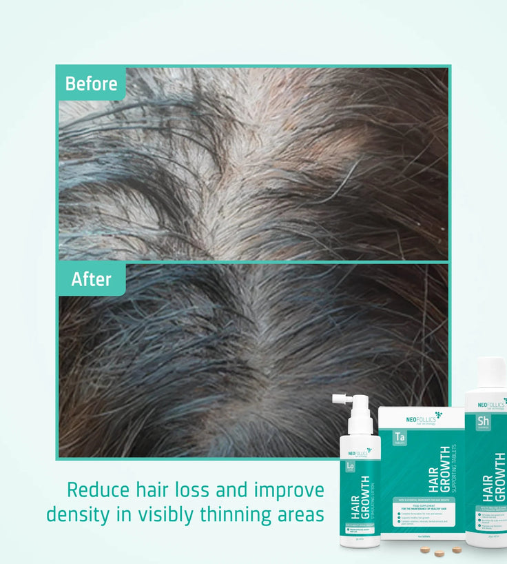 Neofollics Shampoo + Serum + Tabletten