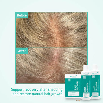 Behandlung von mäßigem erblich bedingtem Haarausfall bei Frauen - Hairgivers