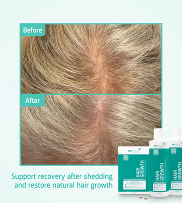 Behandlung von mäßigem erblich bedingtem Haarausfall bei Frauen - Hairgivers