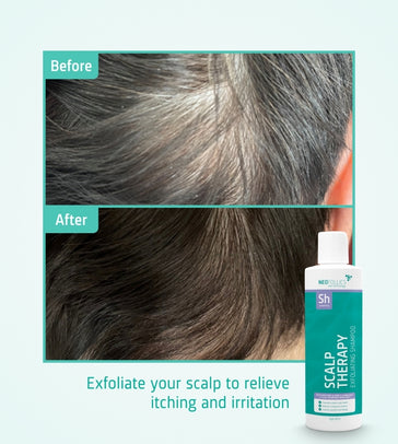 Neofollics Peeling Shampoo - Hairgivers