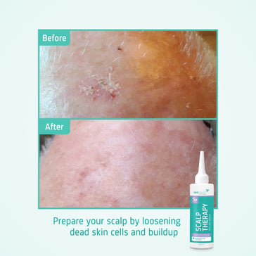 Neofollics Kopfhaut Peeling Serum - Hairgivers