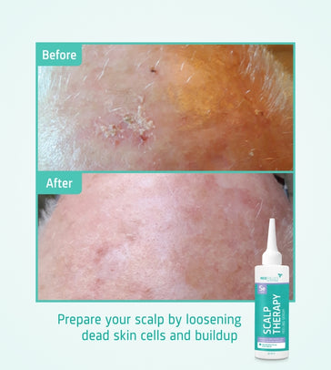 Neofollics Kopfhaut Peeling Serum - Hairgivers