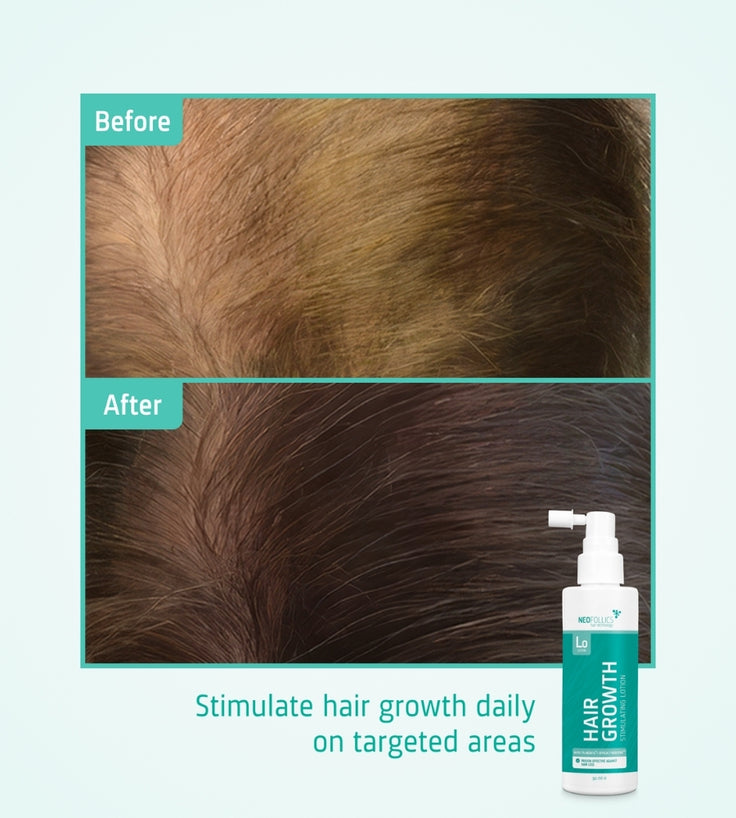 Neofollics Serum gegen Haarausfall 3-Pack (7% Neoxyl)