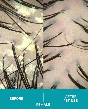 Dandrene Anti-Schuppen Shampoo