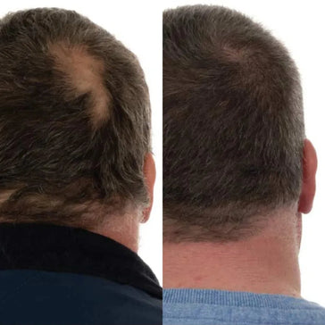 Foligain Haarwuchsbehandlung (Mann) - Hairgivers