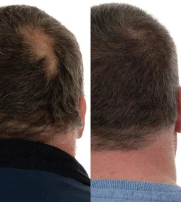 Foligain Haarwuchsbehandlung (Mann) - Hairgivers