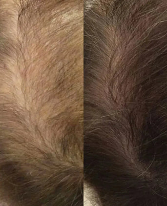 Neofollics Serum gegen Haarausfall 3-Pack (7% Neoxyl) - Hairgivers