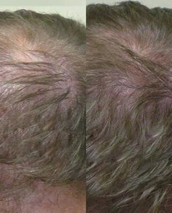 Neofollics Shampoo + Conditioner Starter-Kit - Hairgivers