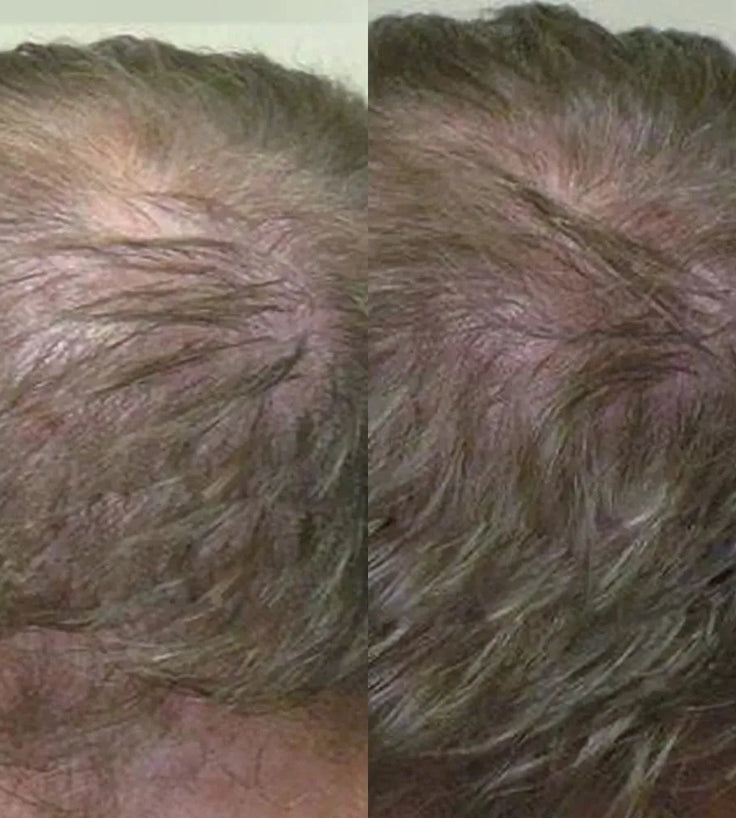 Neofollics Shampoo gegen Haarausfall (250 ml) - Hairgivers
