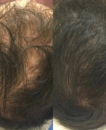 Revita Shampoo gegen Haarausfall (205 ml) - Hairgivers