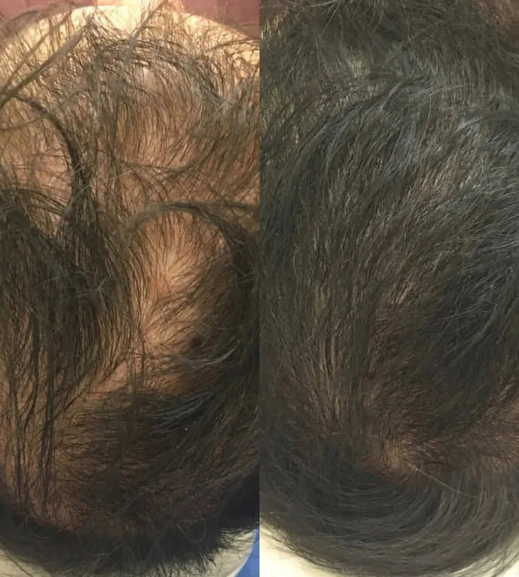 Revita Shampoo gegen Haarausfall (205 ml) - Hairgivers