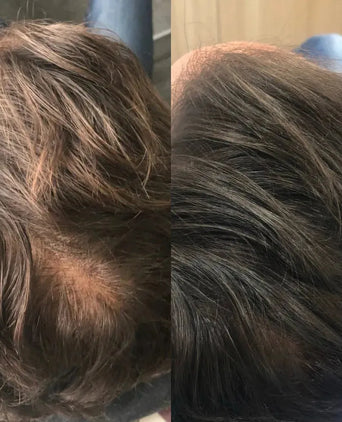 Revita Shampoo gegen Haarausfall (205 ml) - Hairgivers