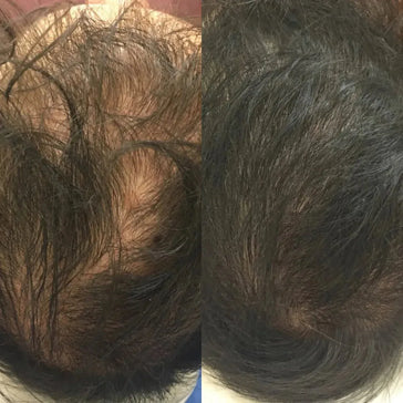 Revita Shampoo gegen Haarausfall 3er-Pack (3x205 ml)