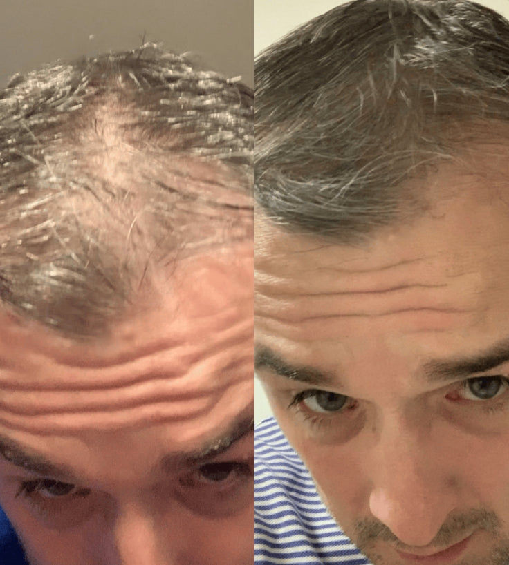 Scandinavian Biolabs Bio-Pilixin Hairline Booster Nachfüllung (1-Pack)