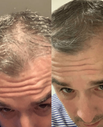 Scandinavian Biolabs Bio-Pilixin Hairline Booster Nachfüllung (3-Pack)