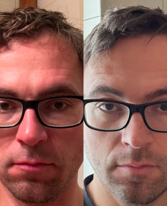 Scandinavian Biolabs Bio-Pilixin Hairline Booster Nachfüllung (3-Pack)