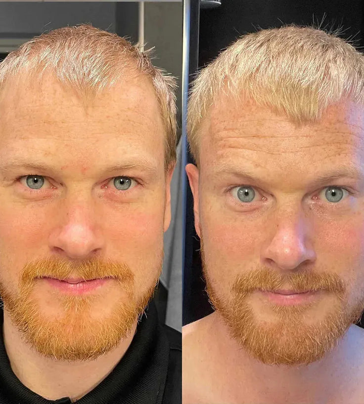 Scandinavian Biolabs Haarwuchsbehandlung (Mann) - Hairgivers