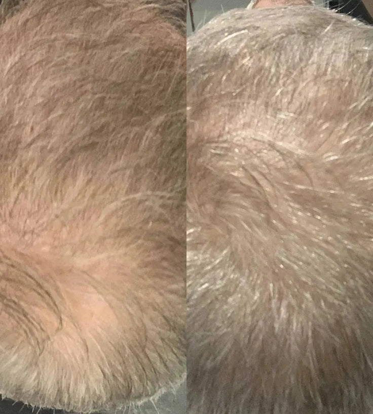 Scandinavian Biolabs Haarwuchsbehandlung (Mann) - Hairgivers